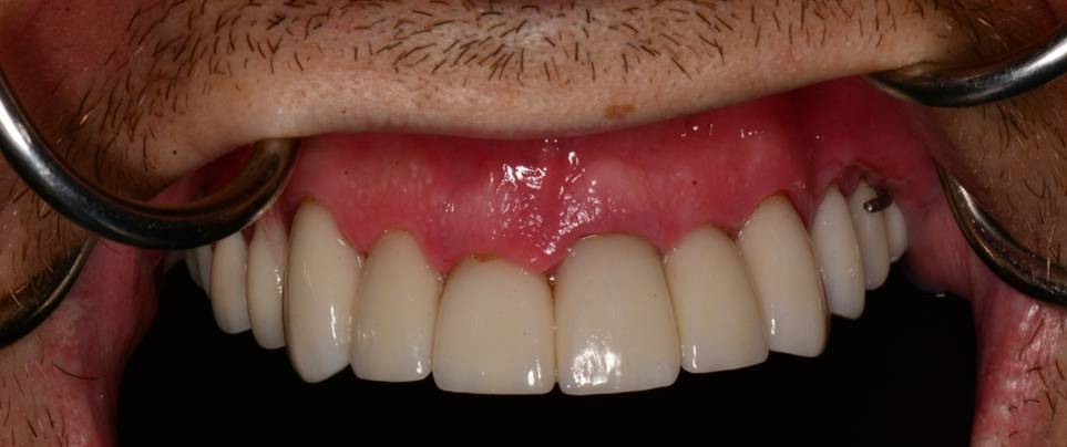 Full mouth after photo