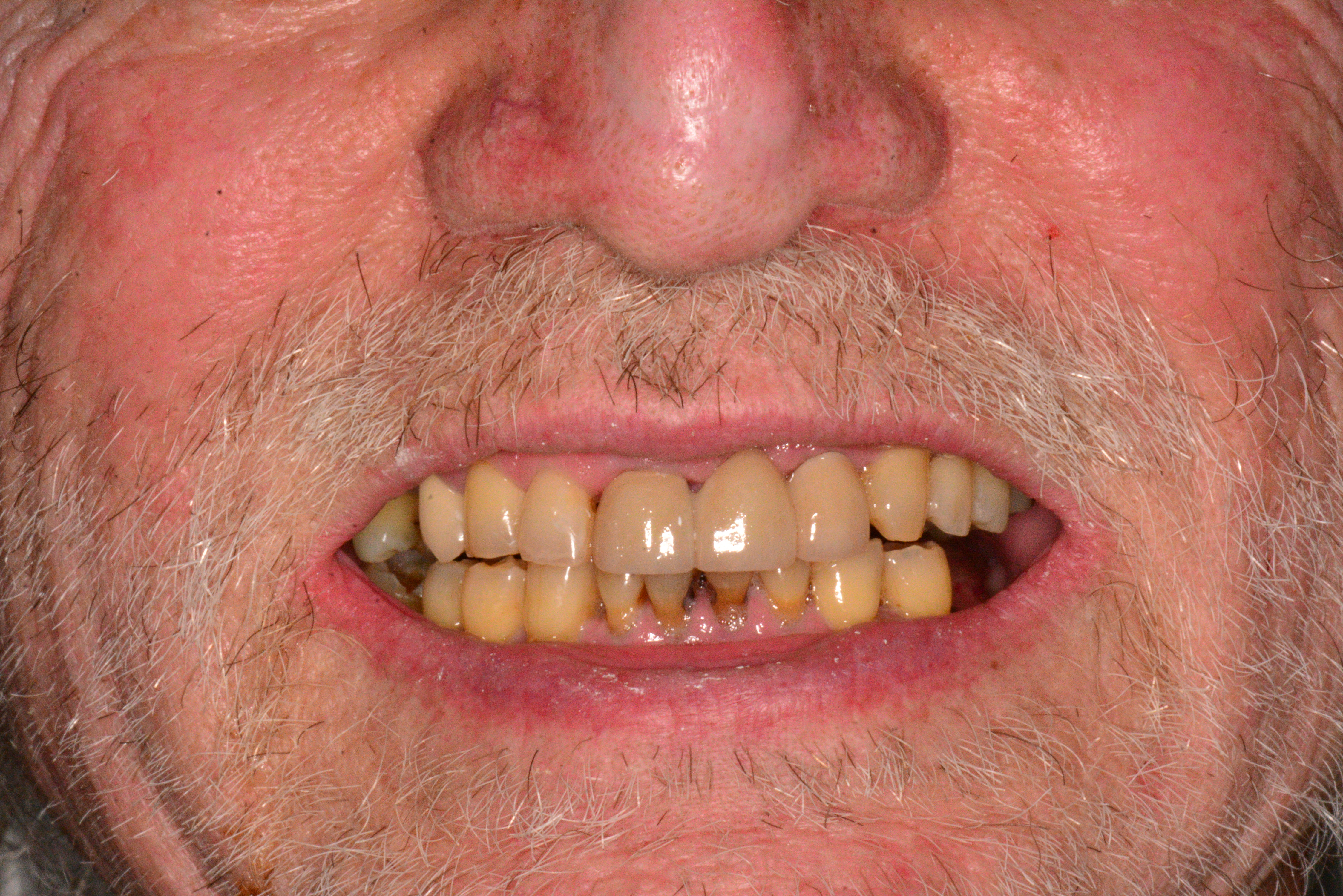 Smile transformation before photo