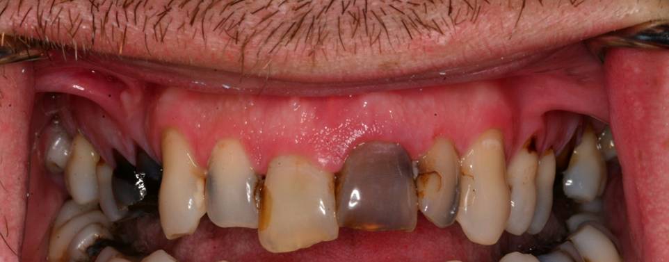 Full mouth before photo